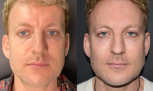 facial contouring with thread lift before after mississauga oakville